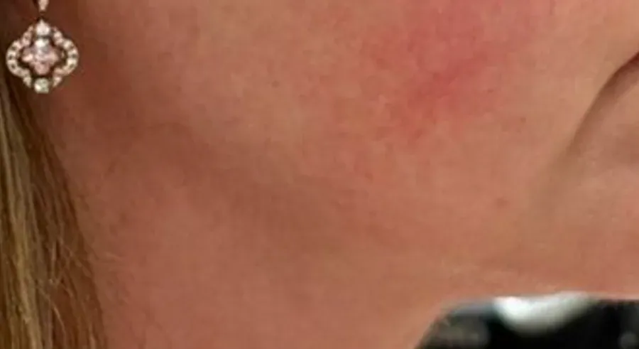 Antes do tratamento de flacidez na linha da mandíbula
