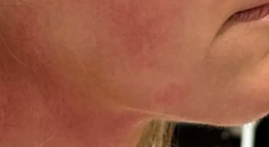 Depois do tratamento com mais firmeza na mandíbula