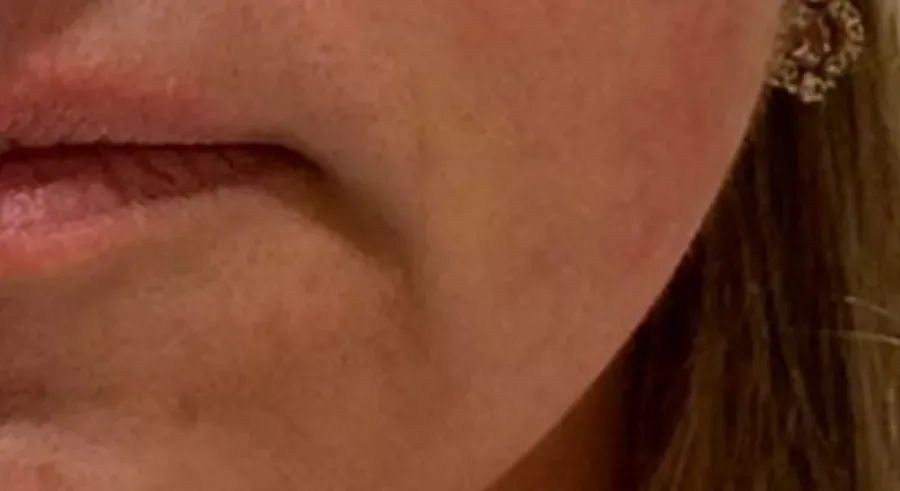 Antes do tratamento no contorno facial