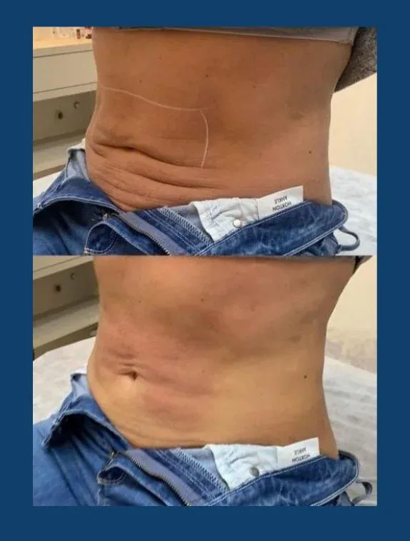 Comparativo de abdômen: acima antes do tratamento, abaixo depois, com a pele mais lisa.