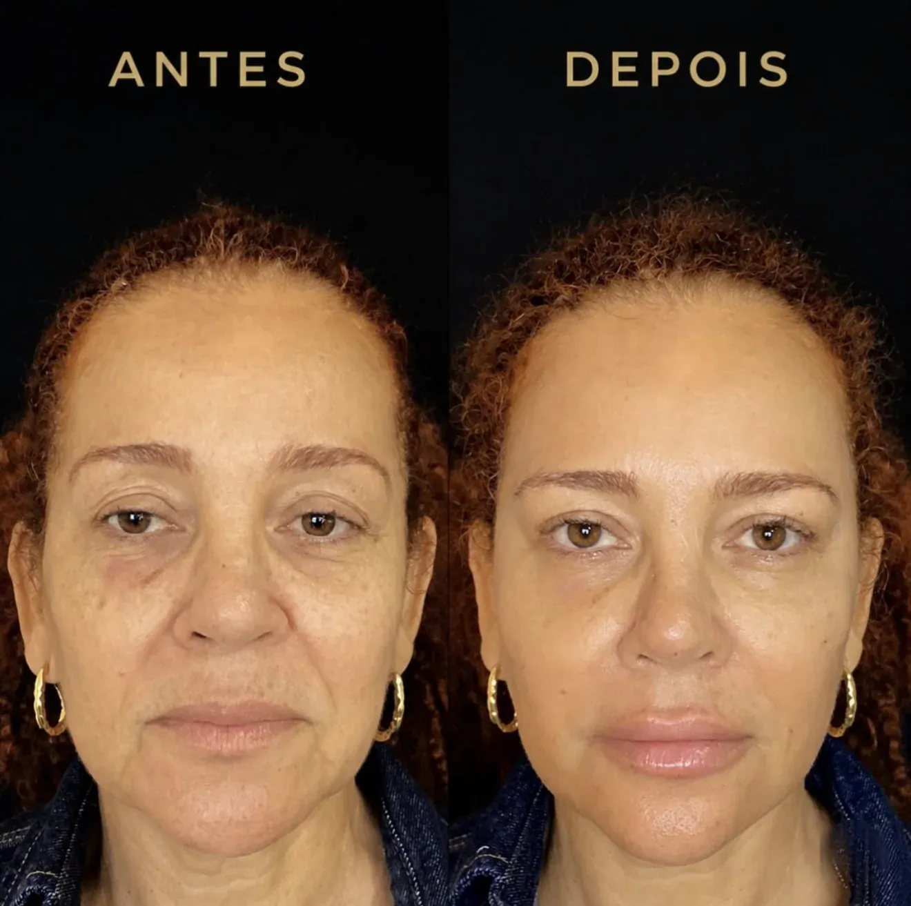 Comparativo de rosto de frente: à esquerda antes do tratamento, à direita depois, com a pele mais firme.