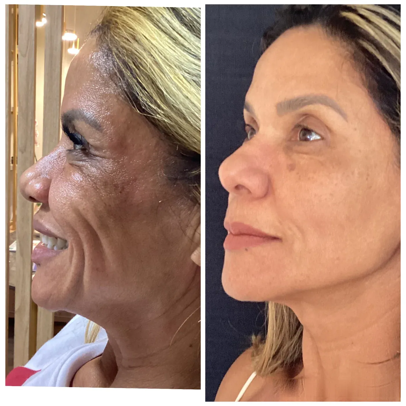 Comparativo de rosto e linha da mandíbula: à esquerda antes do tratamento, à direita depois, com a pele mais firme.